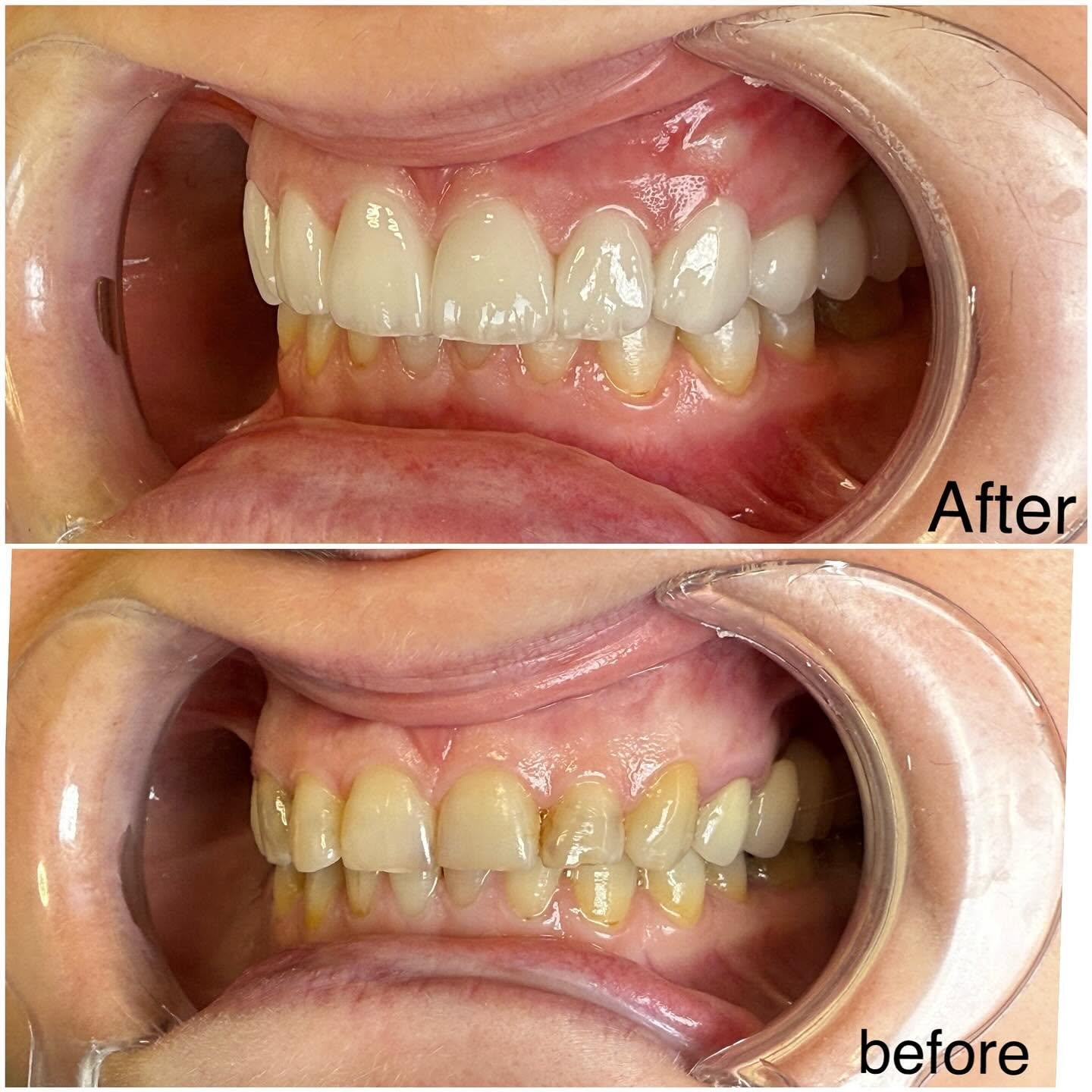 Teeth whitening before and after result